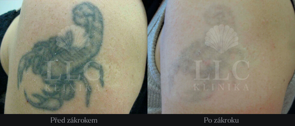 Odstranění tetováže - 2