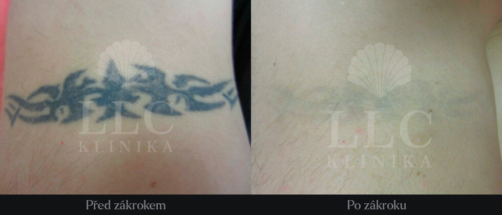 Odstranění tetováže - 1