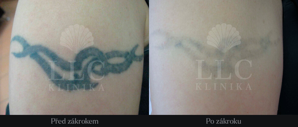 Odstranění tetováže - 2